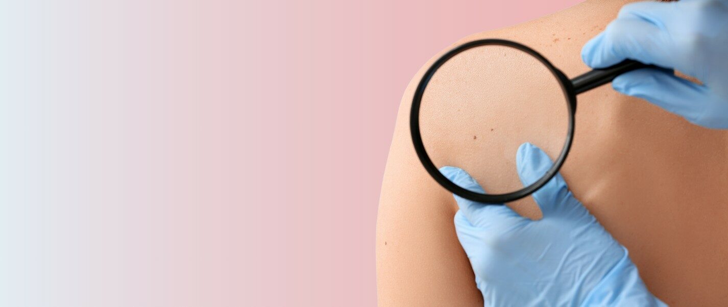 melanoma sintomi